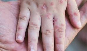 5 children die from meningococcal disease and measles